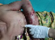Kondisi tangan korban yang mengalami luka gigitan akibat terkaman buaya